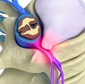 Tratamiento hernia discal